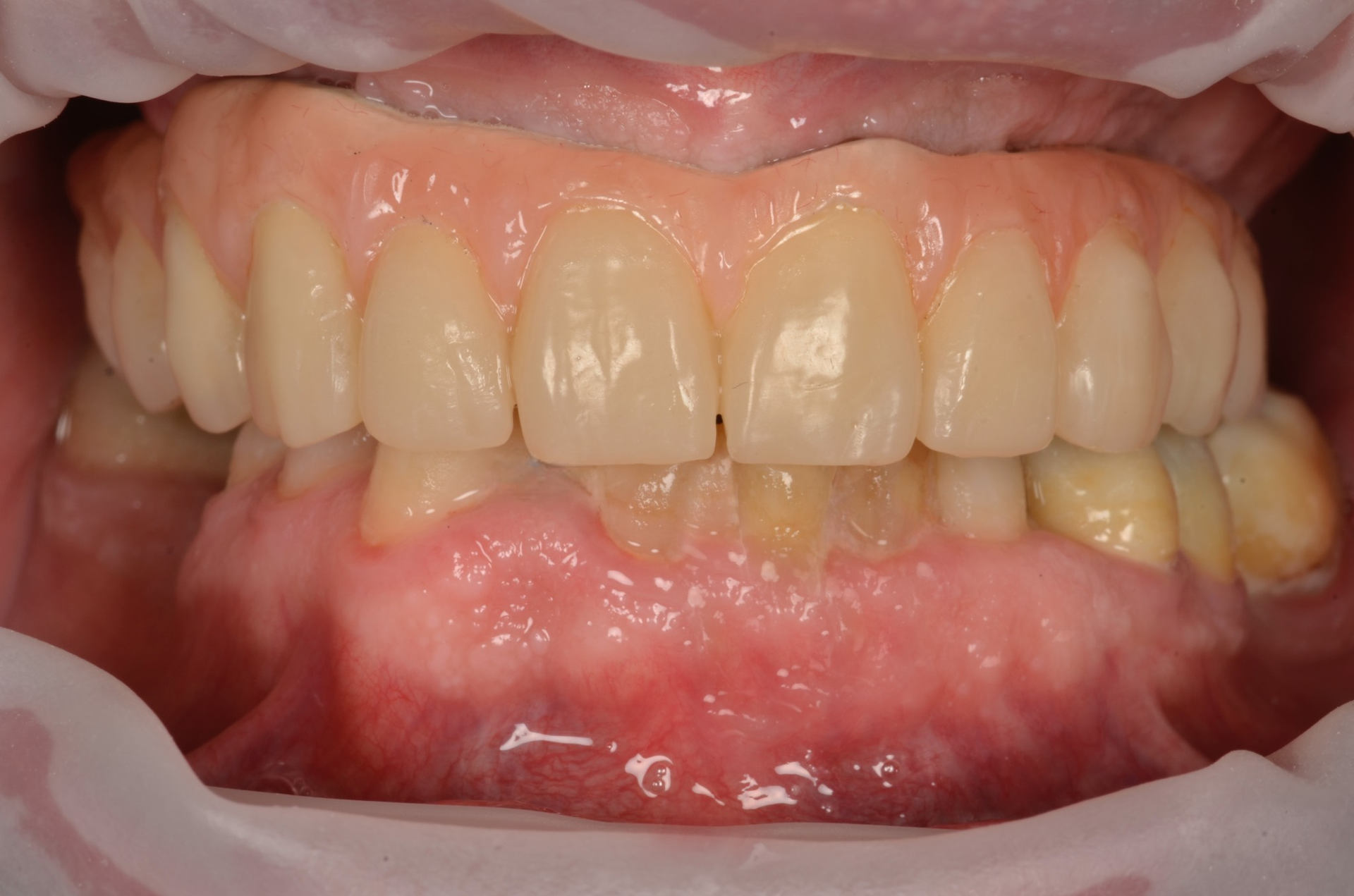 Bocca con denti superiori e inferiori. Gengive rosa. Denti bianchi e ingialliti.
