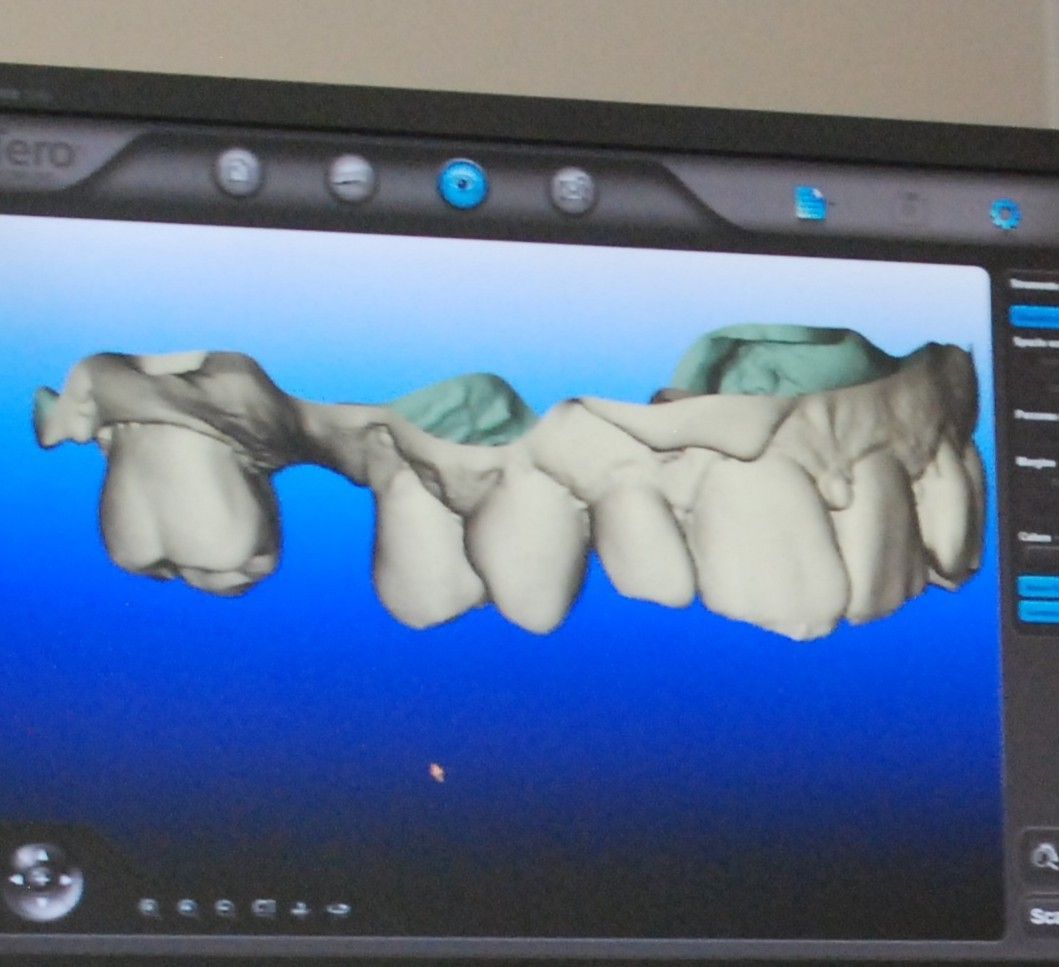 Scansione dentale 3D dei denti su un monitor con sfondo blu e rendering sfumato grigio/verde.