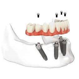Illustrazione di una mascella con impianti dentali e una serie di denti superiori, che mostra il processo di sostituzione.