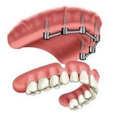 Illustrazione odontoiatrica di protesi dentarie, che mostra le protesi superiori e inferiori e una barra con impianti.
