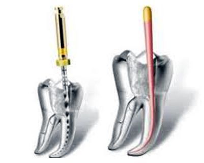 Sezione trasversale del dente sottoposto a devitalizzazione; strumento medico nel canale del dente; un altro dente che mostra l'otturazione completata.