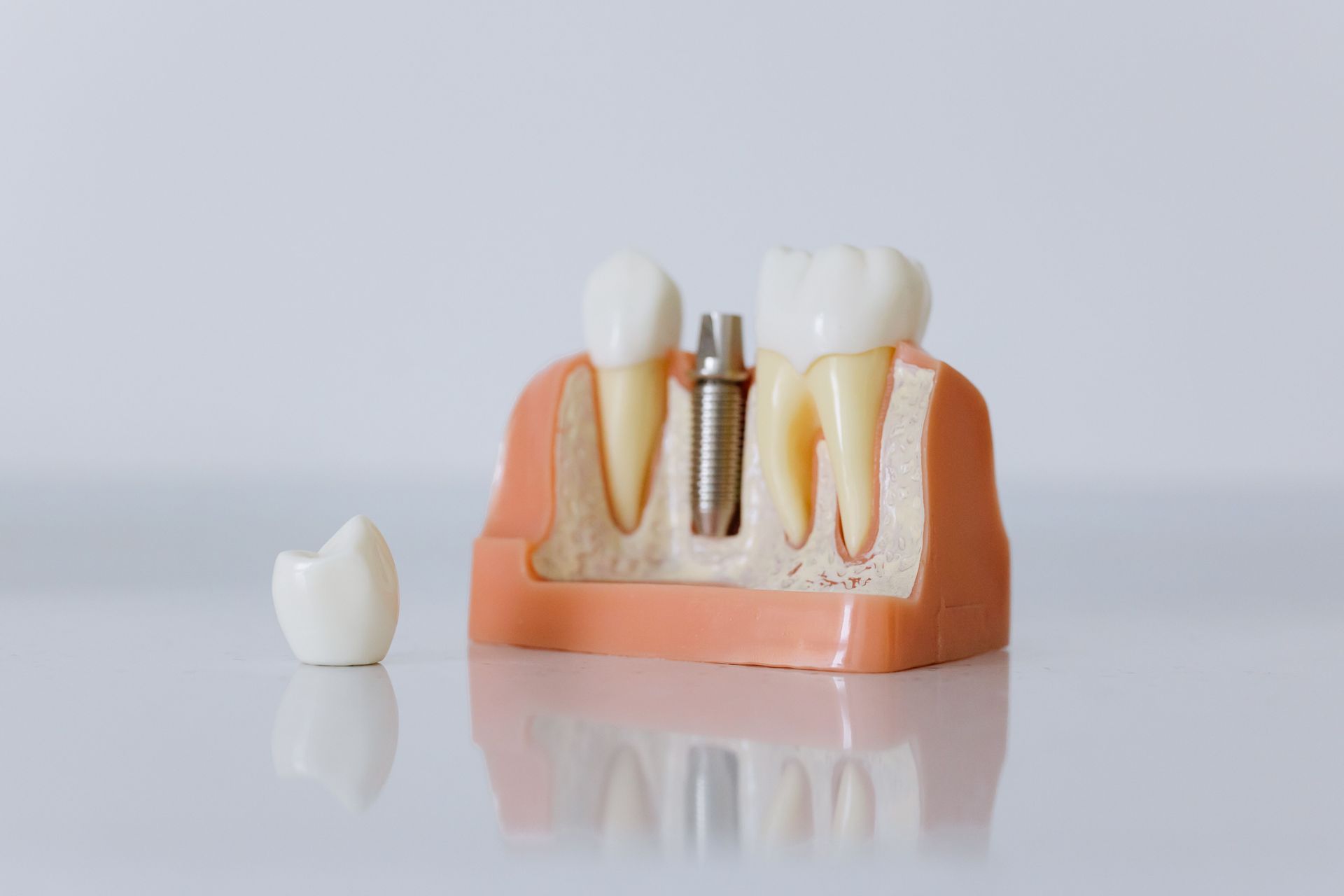 Modello di impianto dentale, implantologia a Torino