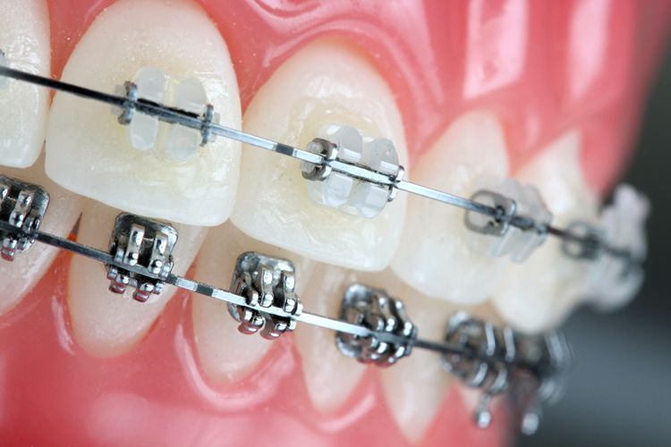 Apparecchio ortodontico fisso - Studio Dentistico Oria Torino