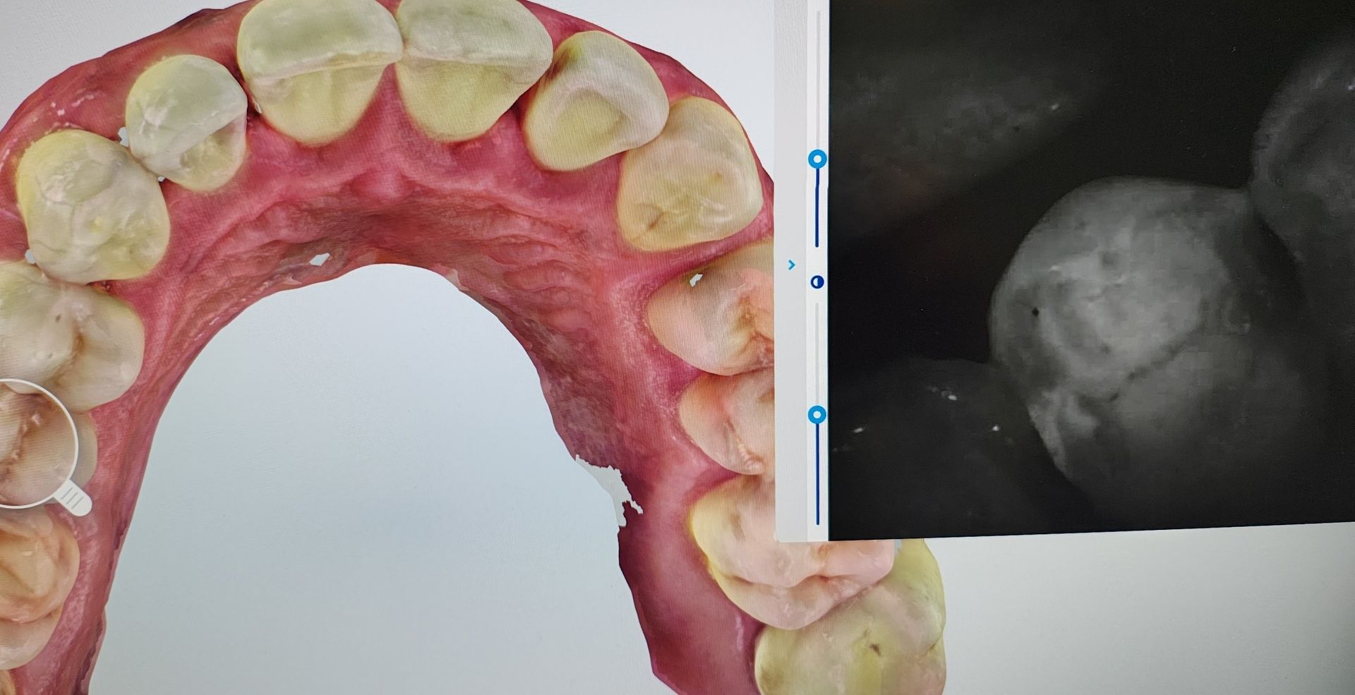 Scansione dentale digitale e radiografia che mostrano i denti superiori, evidenziando l'anatomia orale e i potenziali problemi.