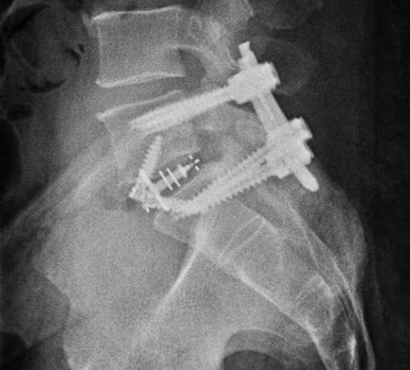 Radiografia de coluna lombar mostrando coluna com espondilolistese após tratamento com artrodese (fusão) das vértebras acometidas.