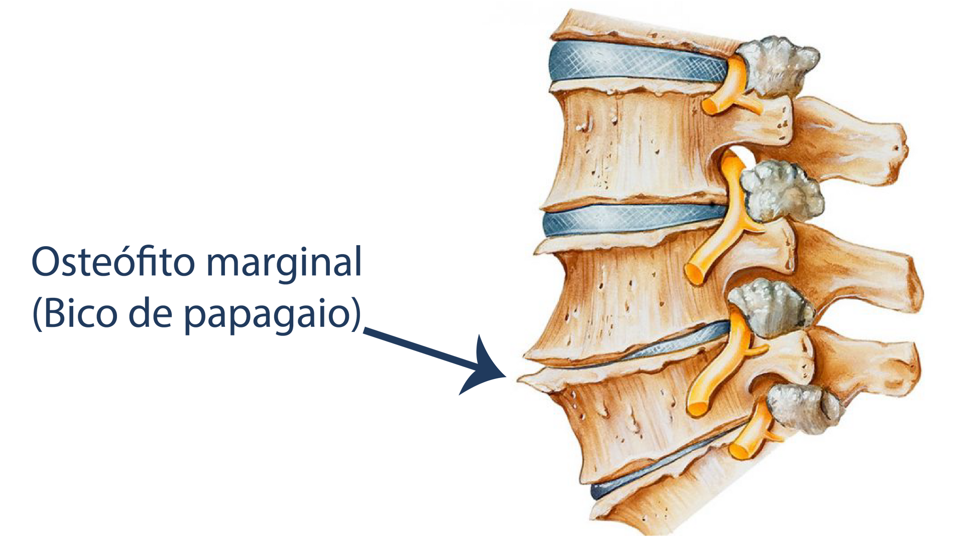 Osteófito marginal ilustração
