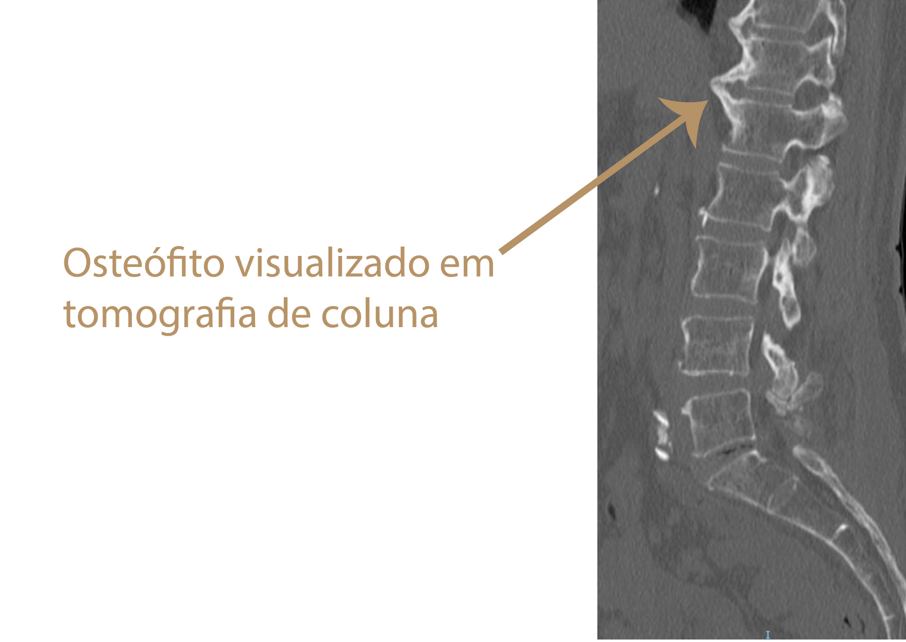 Osteófito em radiografia de coluna