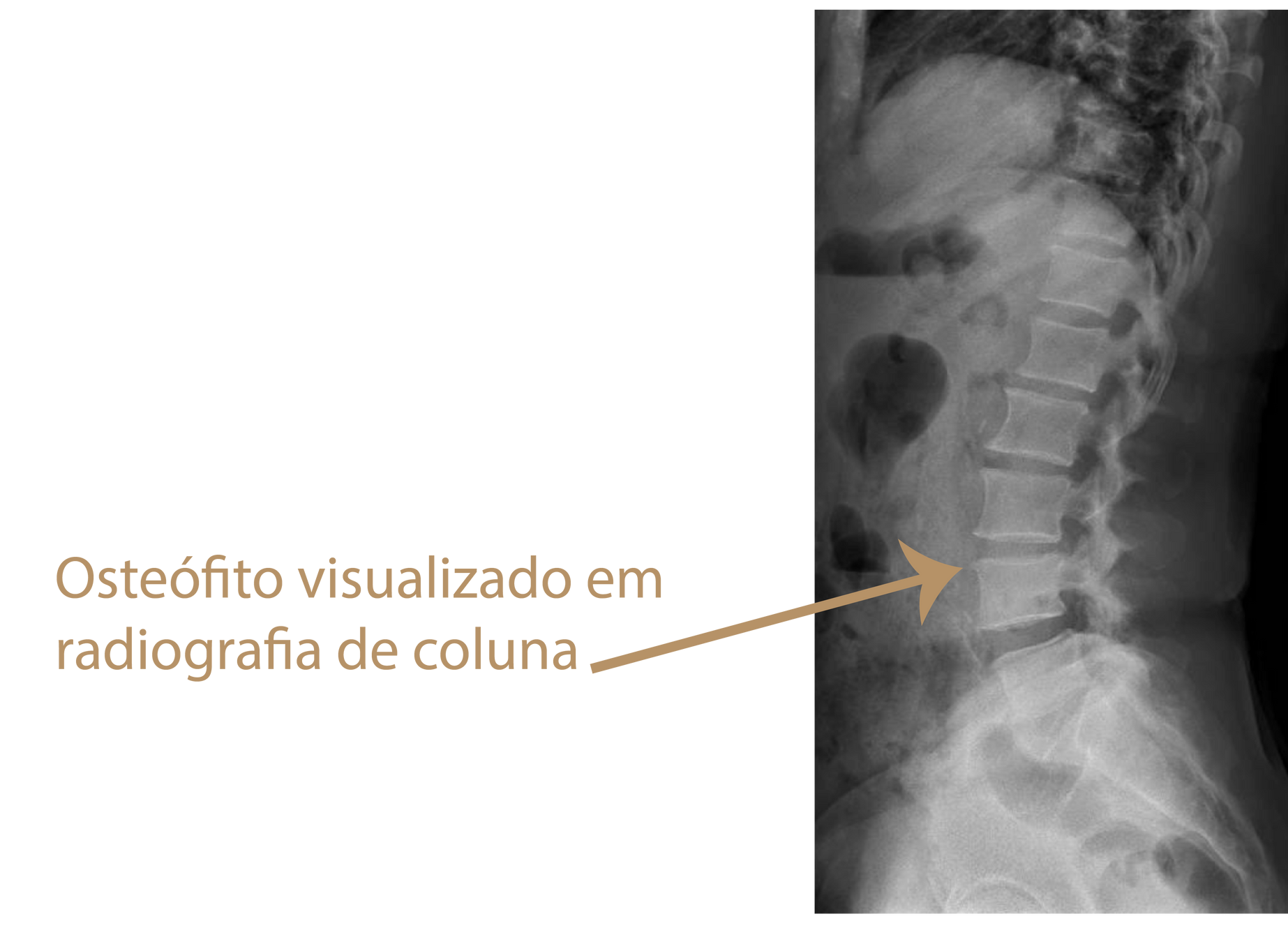Osteófito em tomografia computadorizada