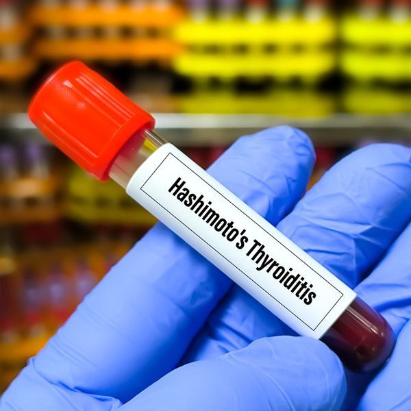 Gloved hand holding a vial labeled “Hashimoto’s Thyroiditis” against a blurred laboratory background