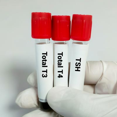 Gloved hand holding three blood test tubes labeled Total T3, Total T4, and TSH with red caps for Hypothyroidism tests
