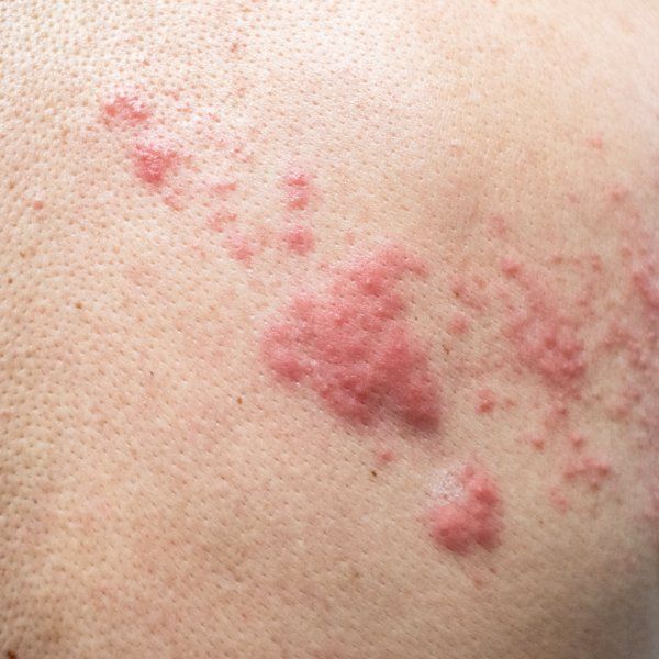 Shingles Treatment in NYC