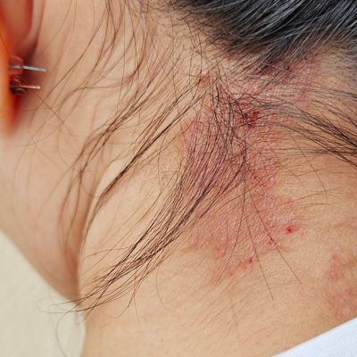 Allergic Reactions Are A Common Symptom of Alpha-Gal Syndrome Red, irritated skin allergic reaction on the back of a person's neck near the hairline.