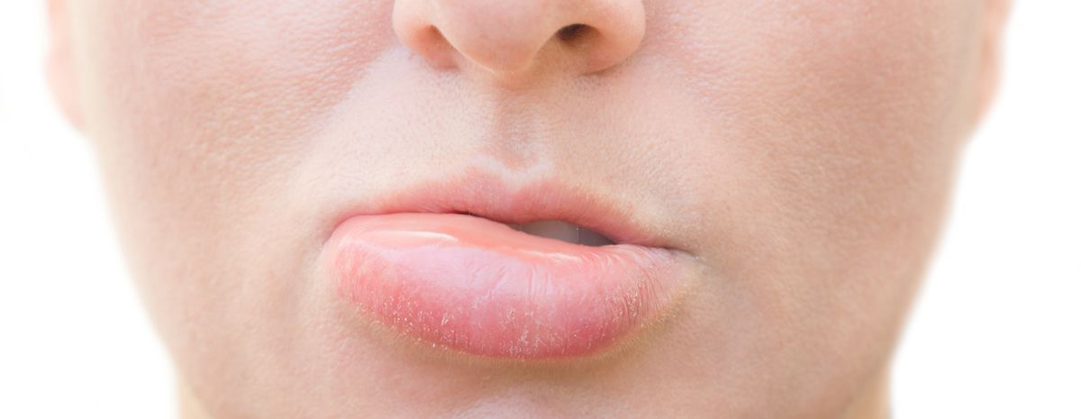 Swelling of the lips is a symptom of Alpha-Gal Syndrome Close-up of a woman's mouth with swollen lips, a sign she needs Alpha-Gal Syndrome Treatments NYC by Dr. Dana Cohen