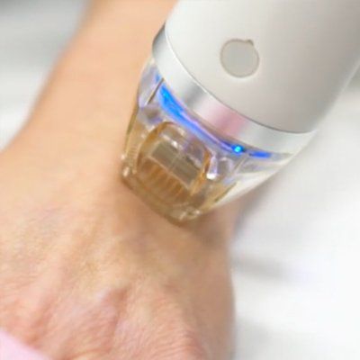 How Radio Frequency Treatments Work. Non Surgical Skin Tightening with Collagen Induction Therapy and Radio Frequency Treatments in Manhattan New York 11009