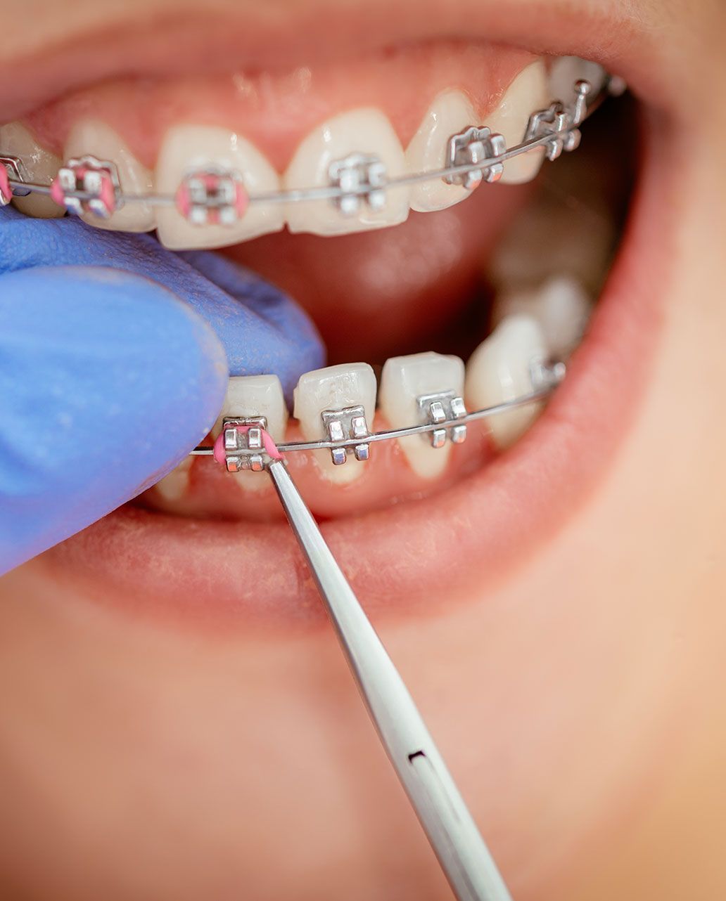 Brackets metálicos