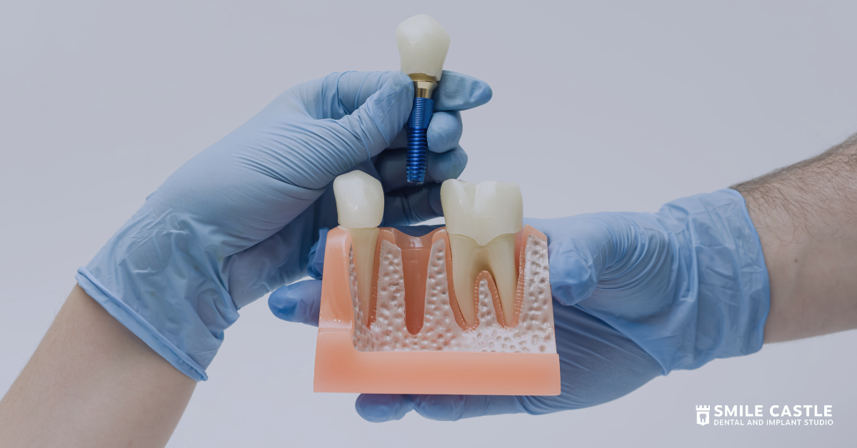 Dental implant placement on a tooth model, showing missing tooth replacement in Chilliwack.