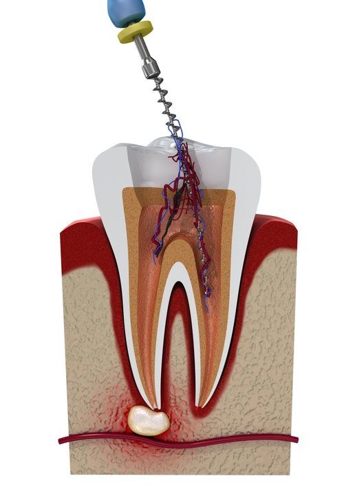root canal