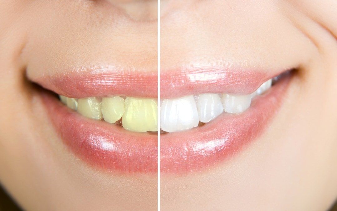 TEETH DENTISTRY