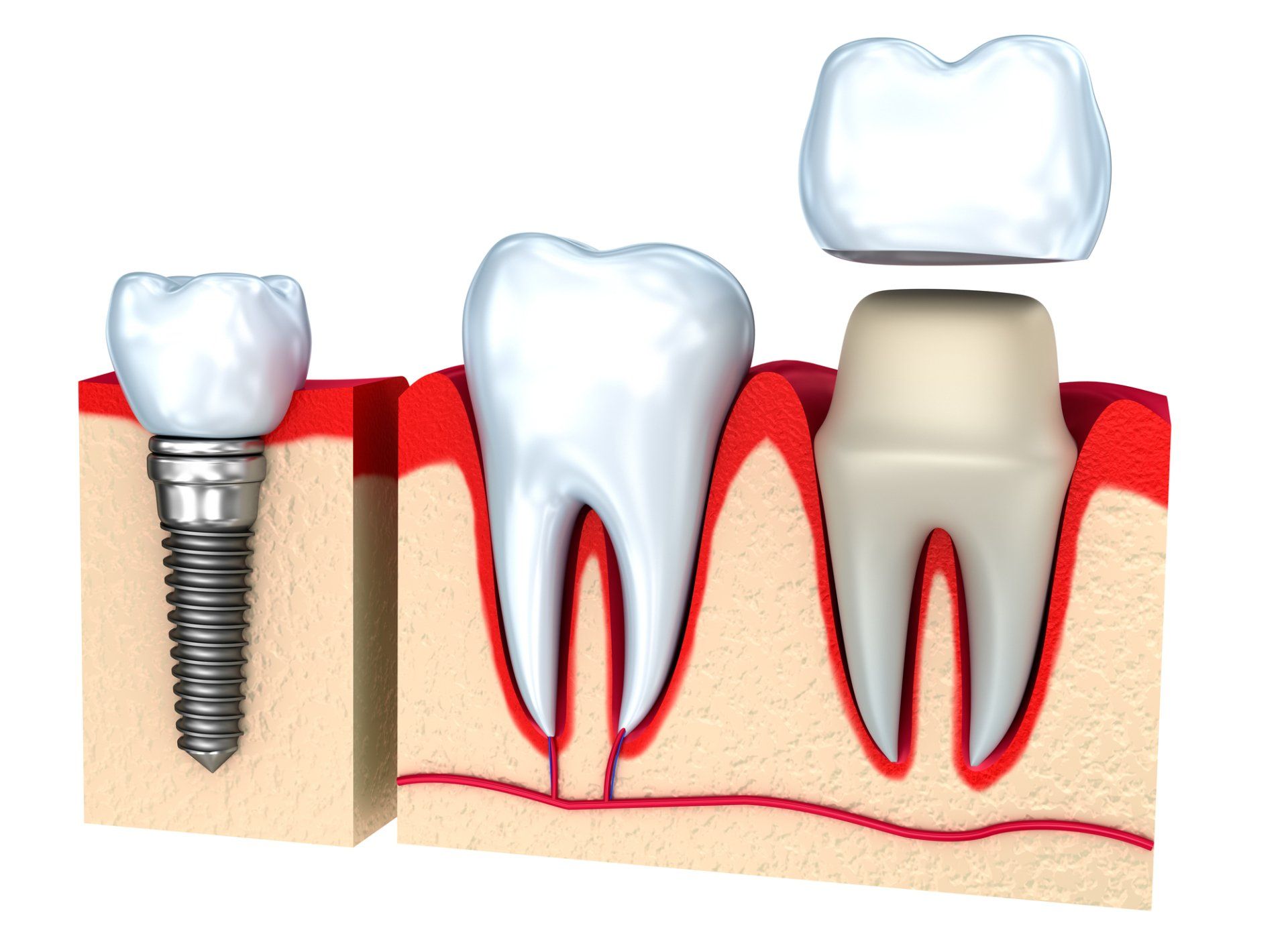 DENTAL CROWNS