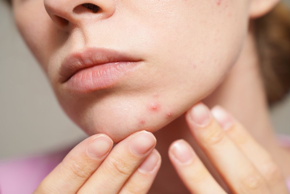 Hands examining a small red pimple on a person's chin