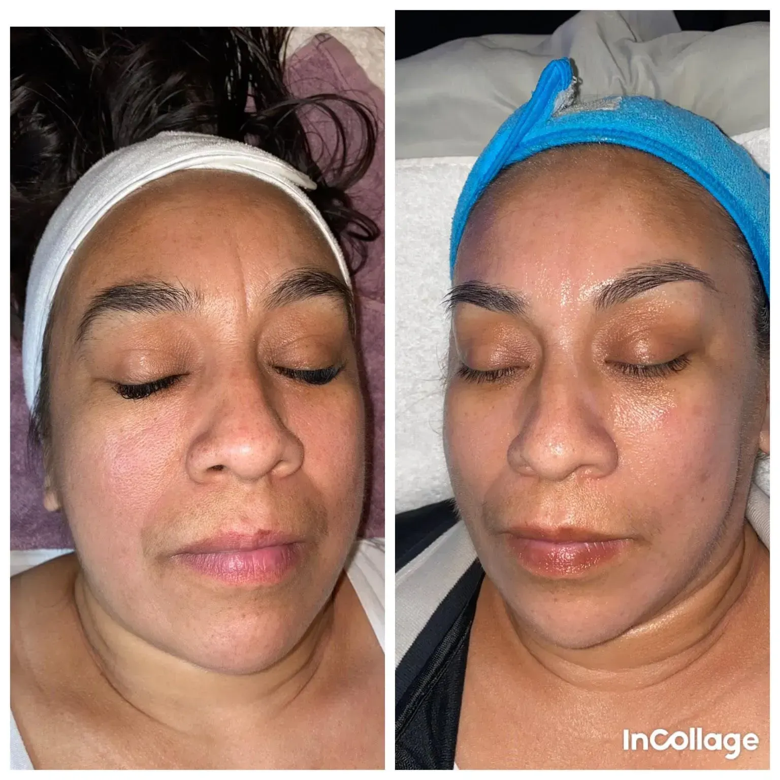 Side-by-side close-up of a face before and after skincare, with headbands and eyes closed