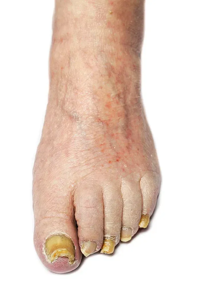 Swollen foot with yellow, thickened toenails and dry, flaky skin