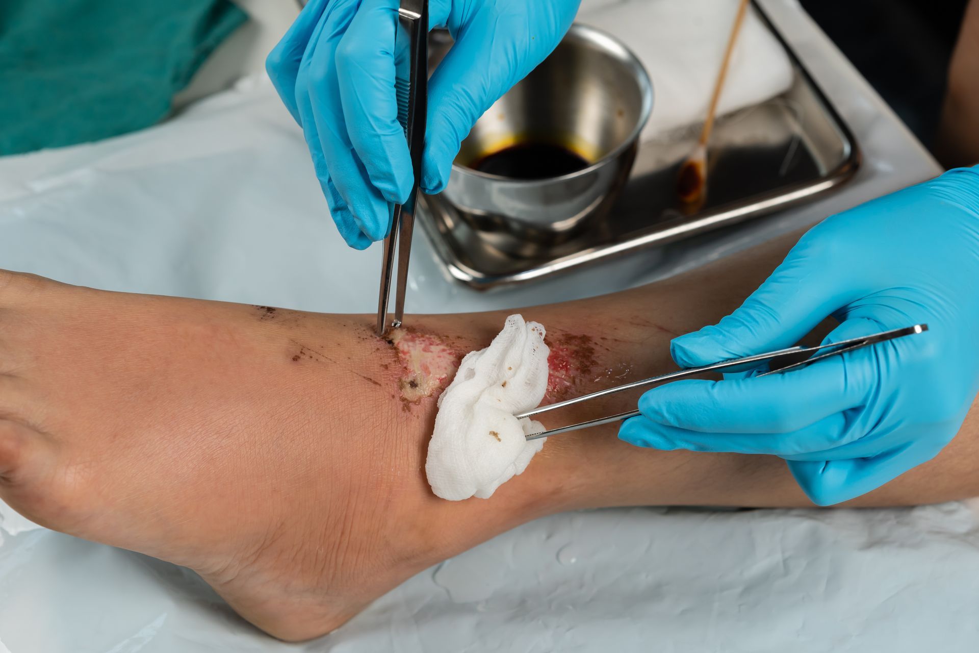 Gloved hands dressing a bandaged ankle with gauze and tweezers in a medical setting