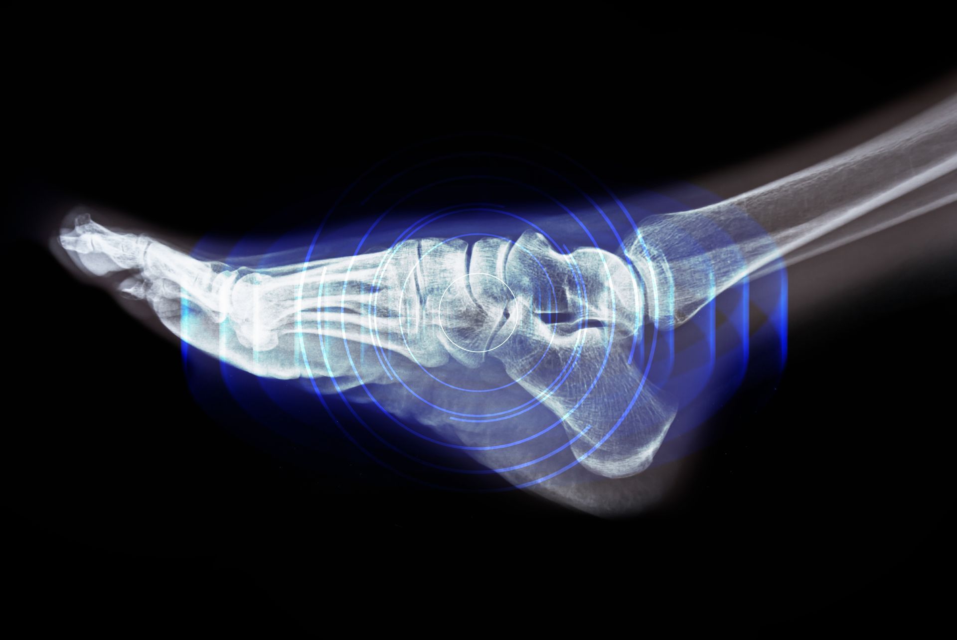 X-ray view of a foot and ankle in white and blue on a black background
