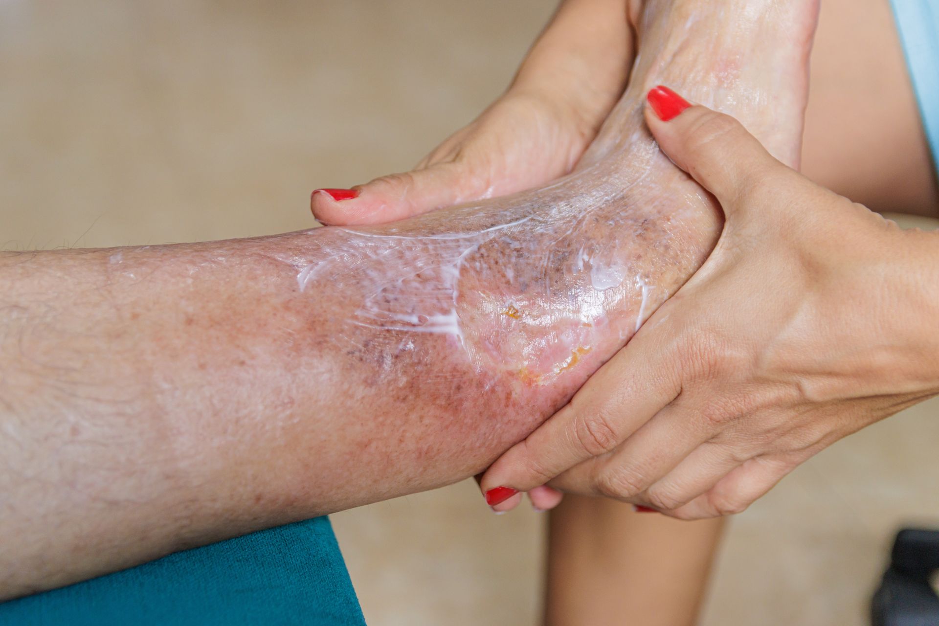 Diabetic Foot Care