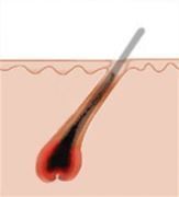Epilazione 1