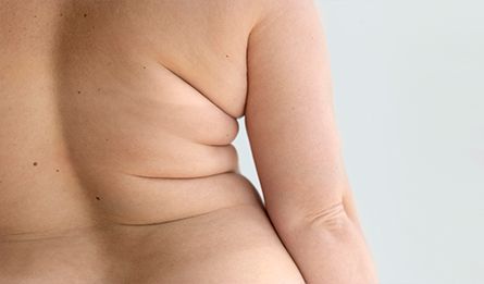 Torsoplastia Alta e Baixa Pós-Bariátrica Torsoplastia Alta e Baixa Pós-Bariátrica