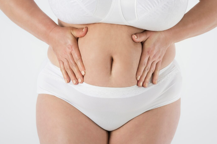 Abdominoplastia pós-bariátrica em São Paulo