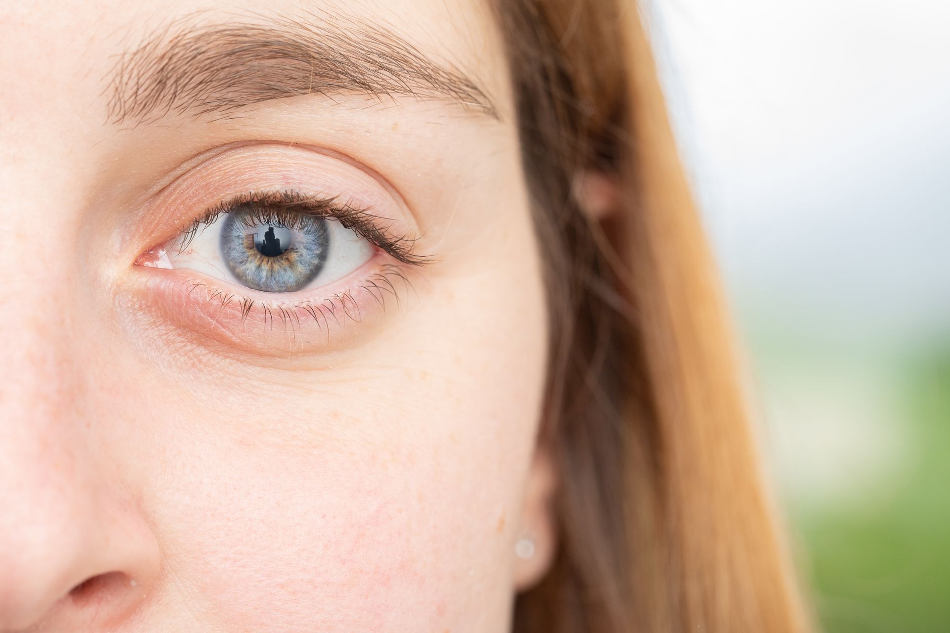 O que é Blefaroplastia