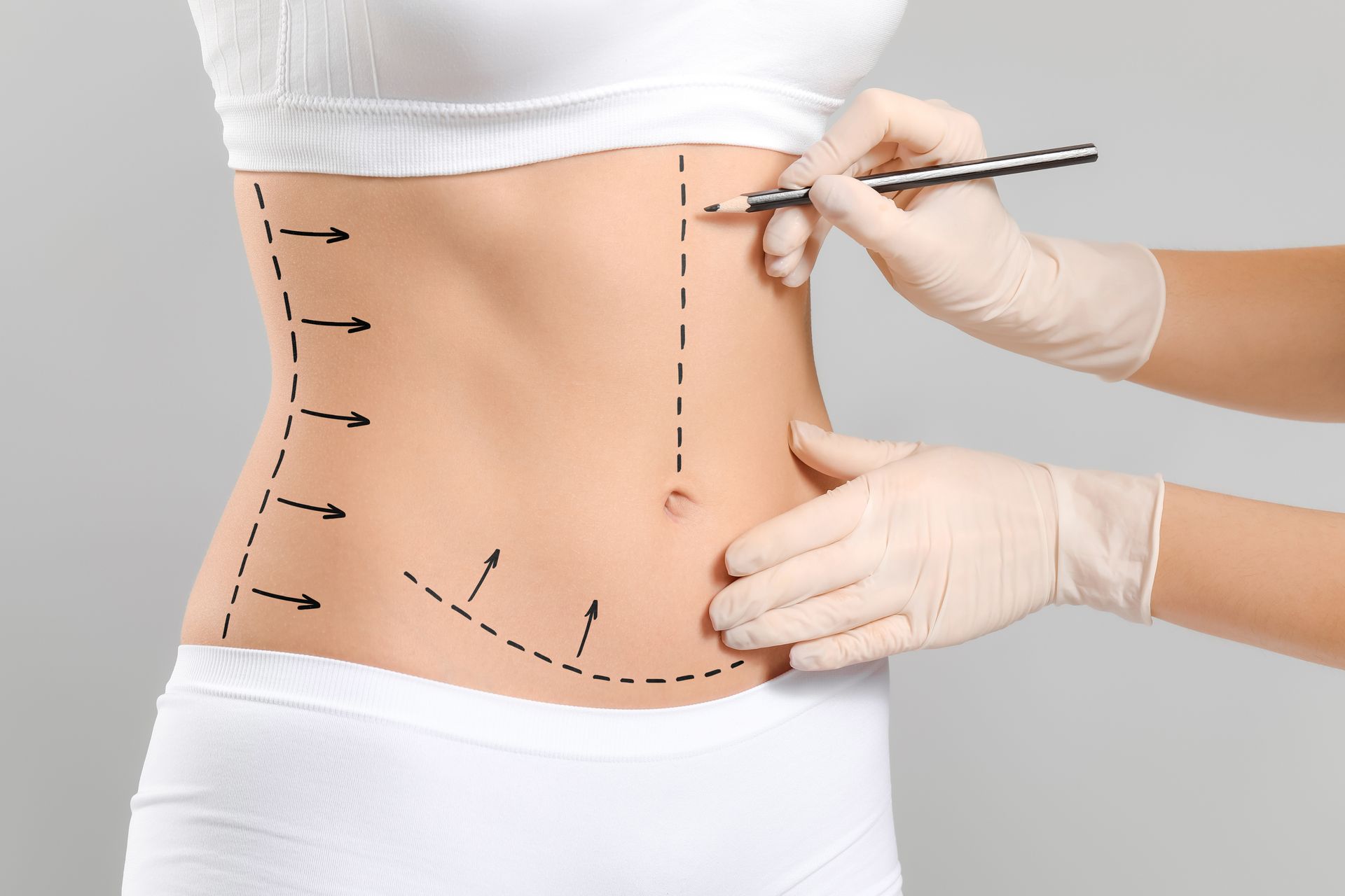 Abdominoplastia e Mini abdominoplastia como funcionam? Abdominoplastia e Mini abdominoplastia como funcionam?