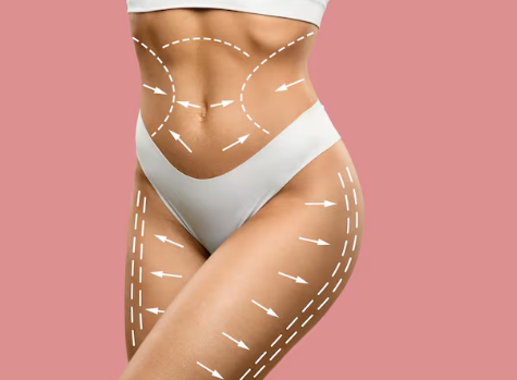Lipoaspiração HD com técnica avançada para definição corporal em SP Lipoaspiração HD com técnica avançada para definição corporal em SP