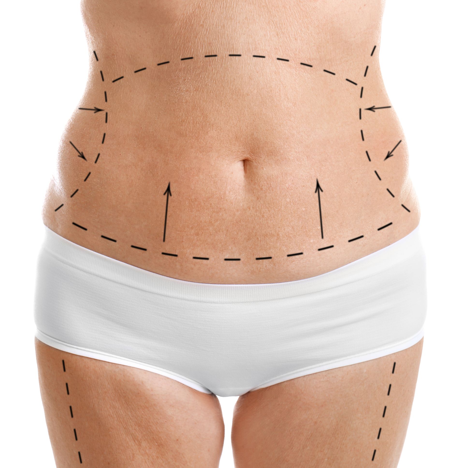 Qual a diferença entre Lipo HD e Lipoaspiração Tradicional Qual a diferença entre Lipo HD e Lipoaspiração Tradicional