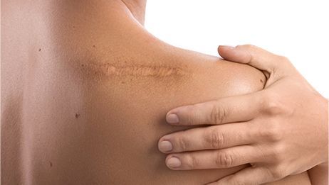 Cirurgia de Correção de Cicatriz Cirurgia de Correção de Cicatriz