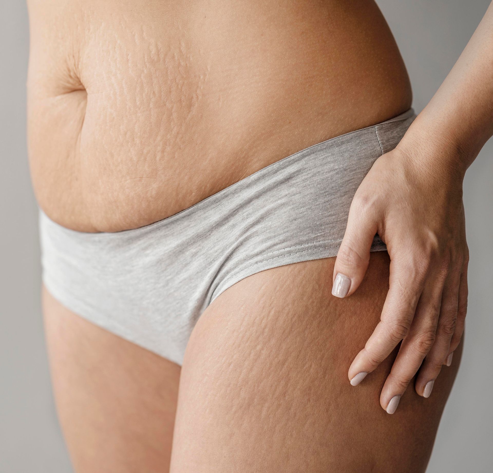 Tratamento cirúrgico para Celulite, como é feito Tratamento cirúrgico para Celulite, como é feito
