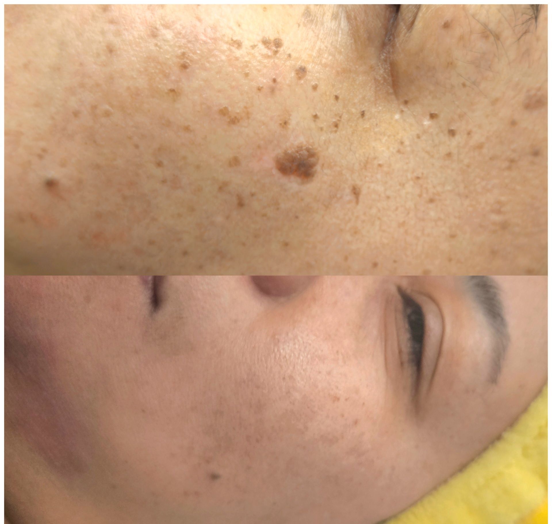Top half of face with freckles and brown spot, bottom half of face with fewer spots.