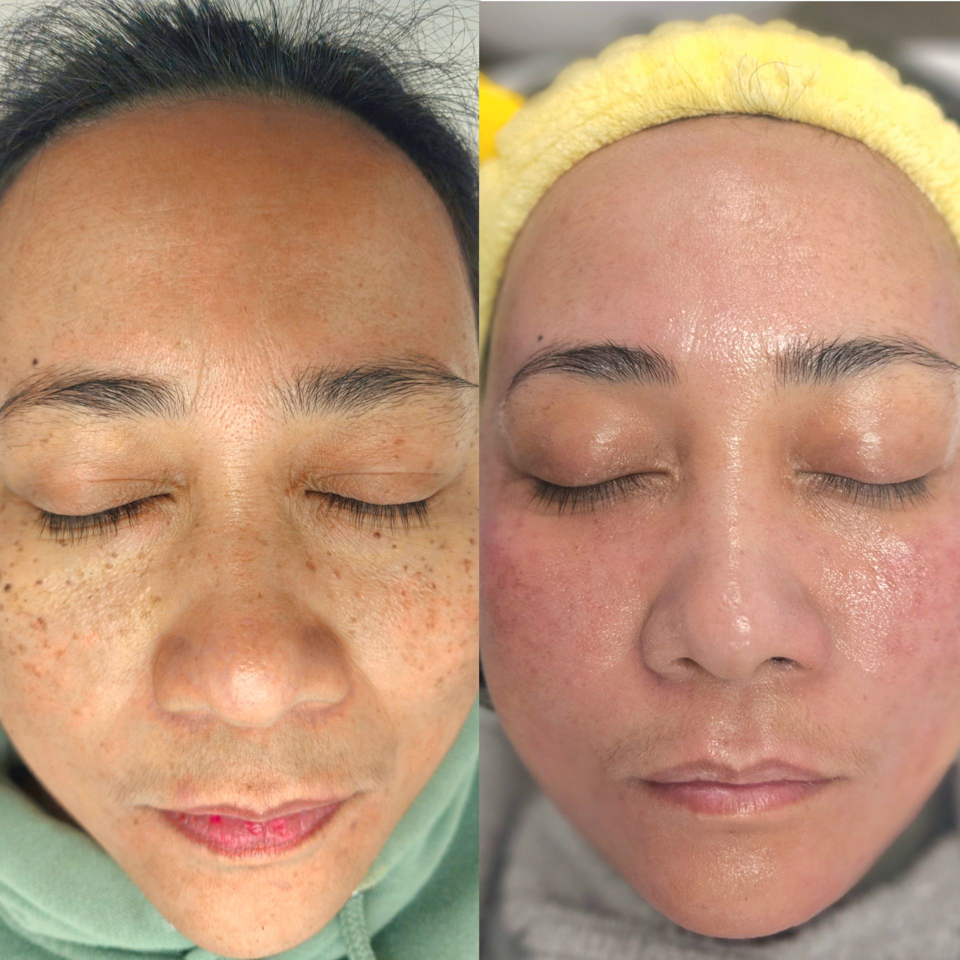 Side-by-side comparison of a person's face. Left shows freckles. Right shows a red, glowing face.