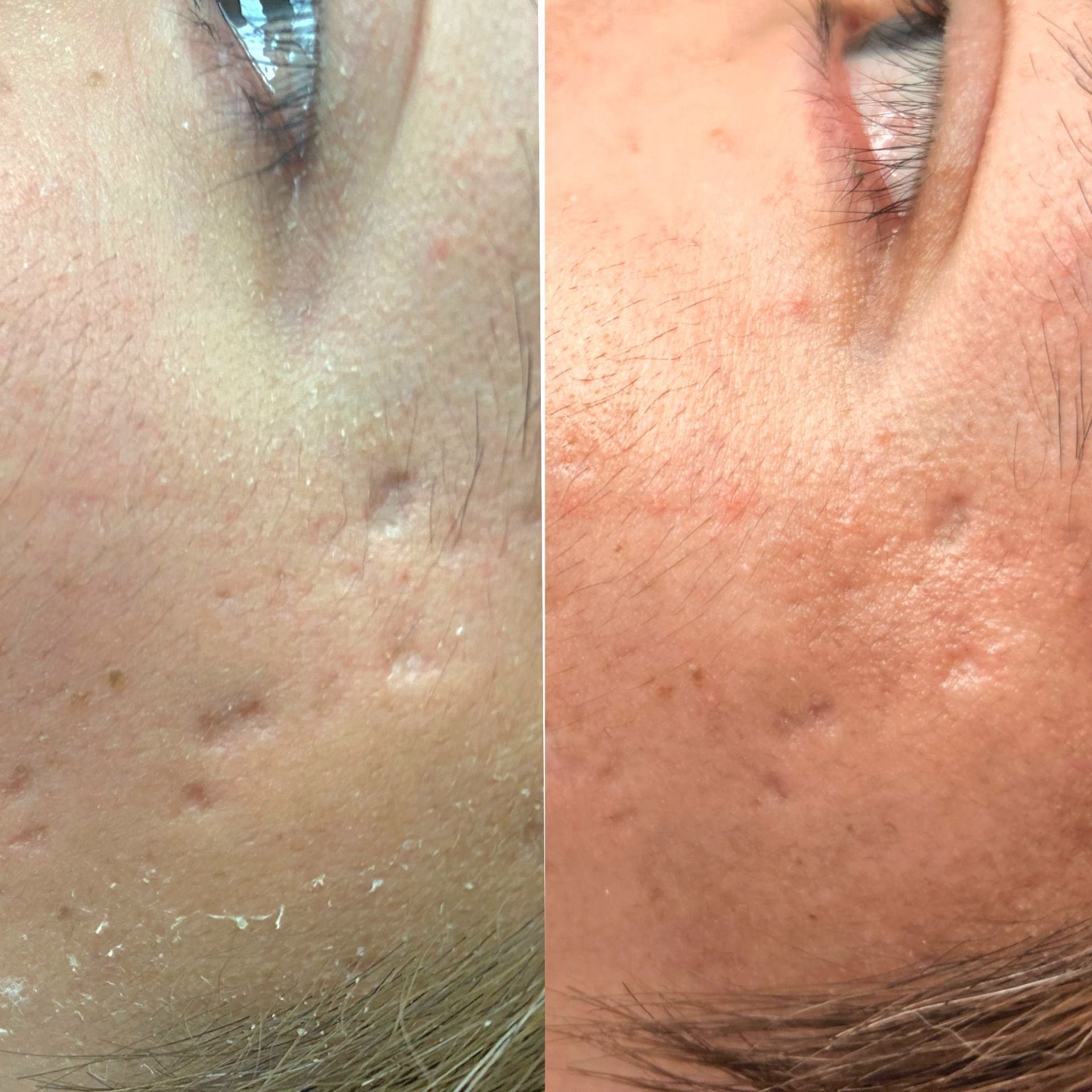 Before-and-after of facial skin. Left: pitted acne scars. Right: improved skin texture with less scarring.