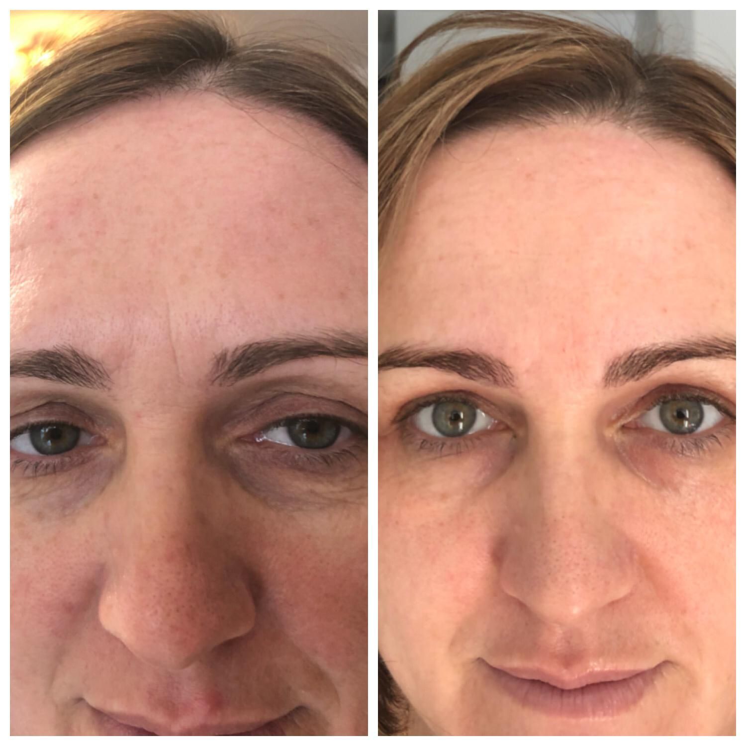 Side-by-side comparison of a person's face. Left side shows wrinkles, right side is smoother.