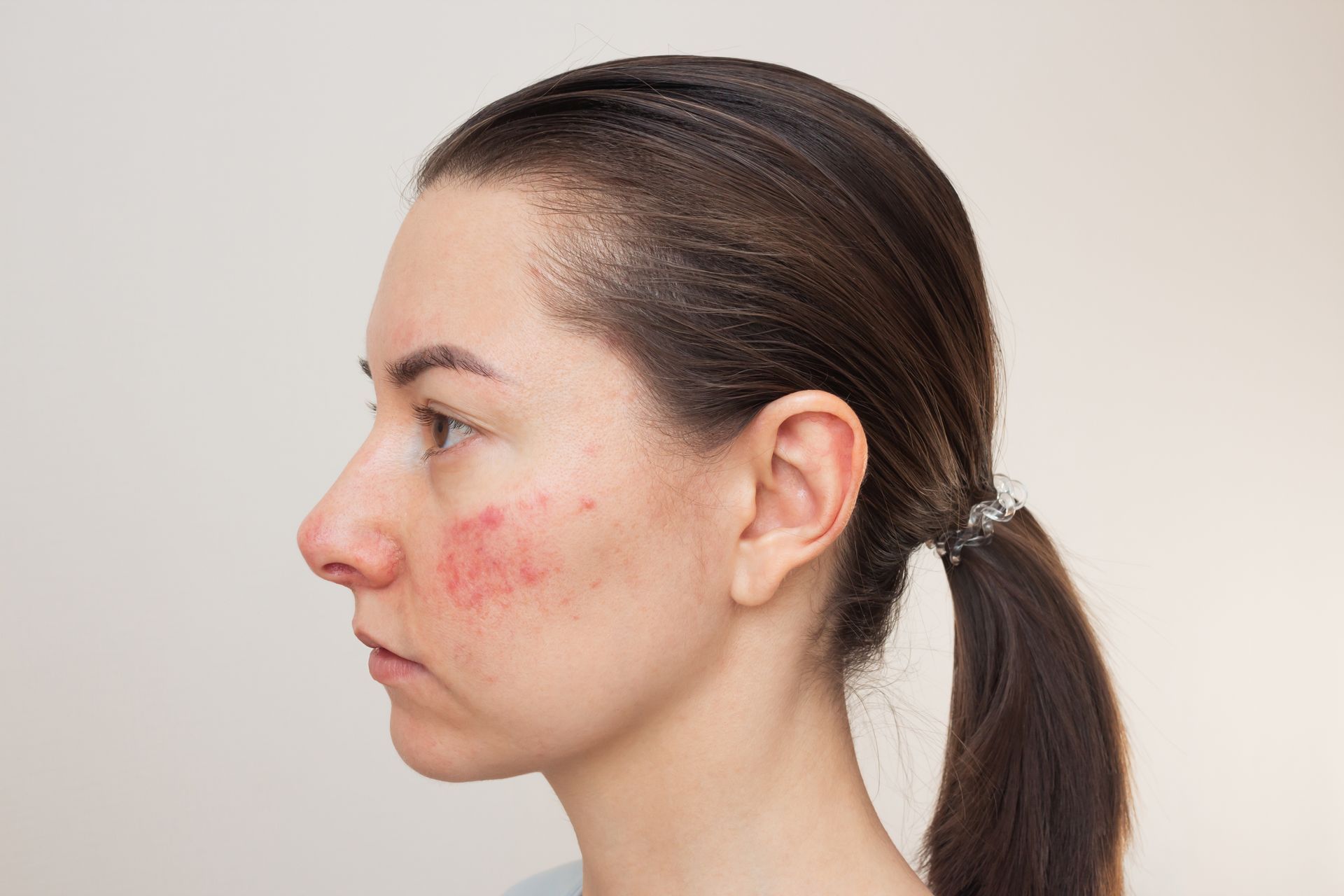 Side profile of a person with red acne marks on the cheek, hair tied back against a plain background