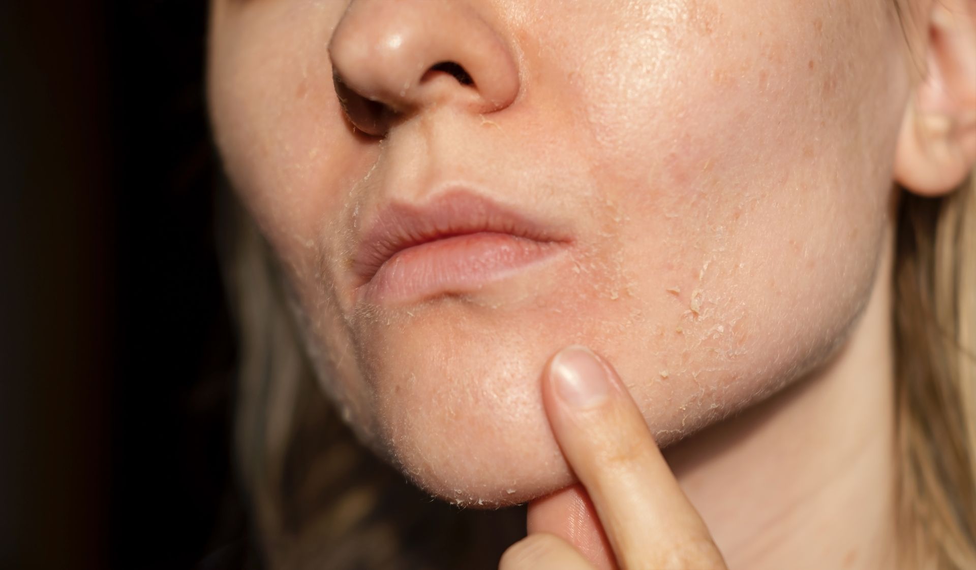 Person's face with dry, flaky skin on the chin and around the mouth, with a finger touching the chin.
