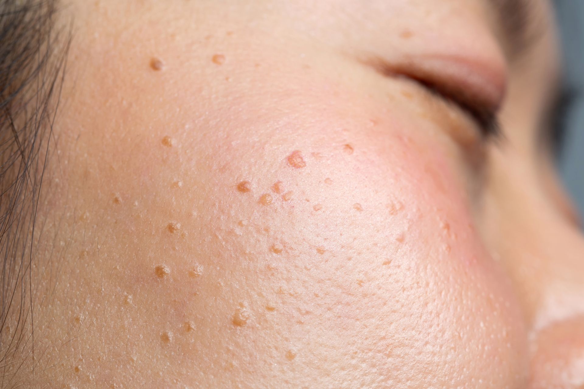 Close-up of a person's face showing multiple small, tan skin growths, possibly warts, near the eye.