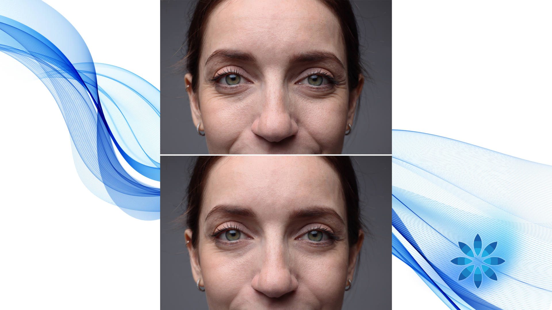 Side-by-side comparison of a person's eyes, showing a reduction of under-eye wrinkles after a treatment.