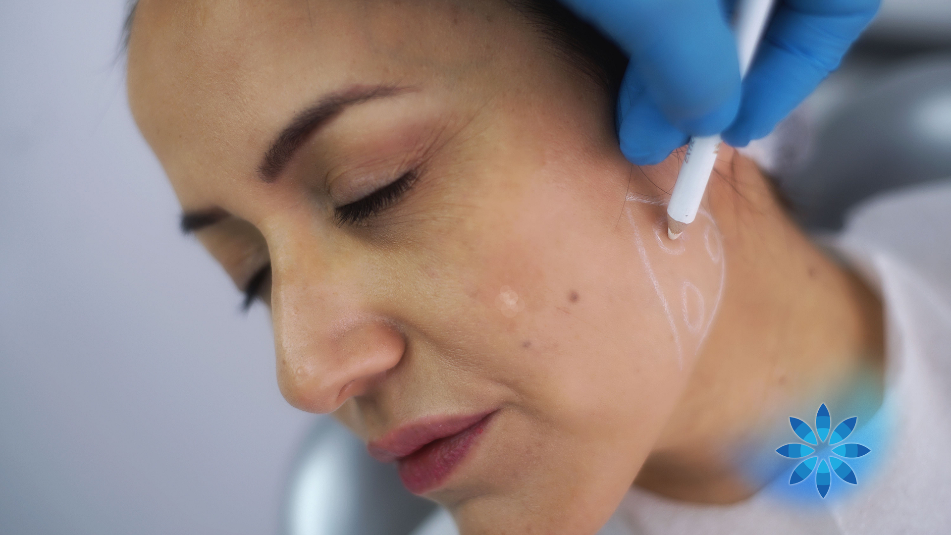 A woman with eyes closed, having markings on her face for a procedure; a hand in a glove holds a pen.