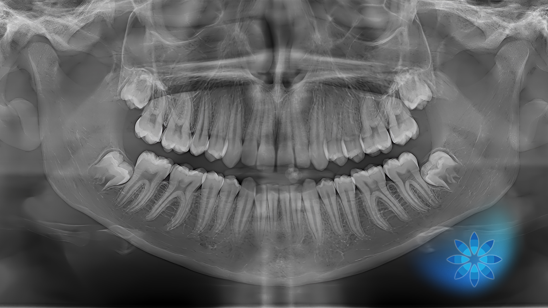 Panoramic dental X-ray showing upper and lower teeth and jaw, with a blue logo in the lower right corner