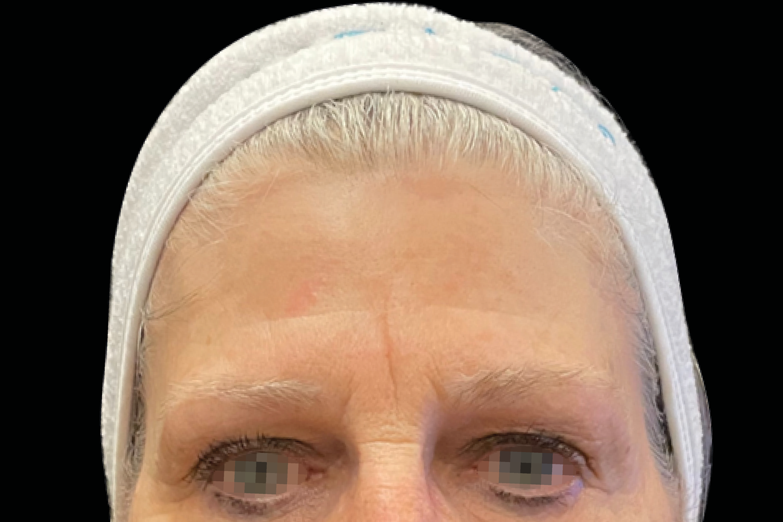 Close-up of a person’s forehead and eyes with a white headband against a black background