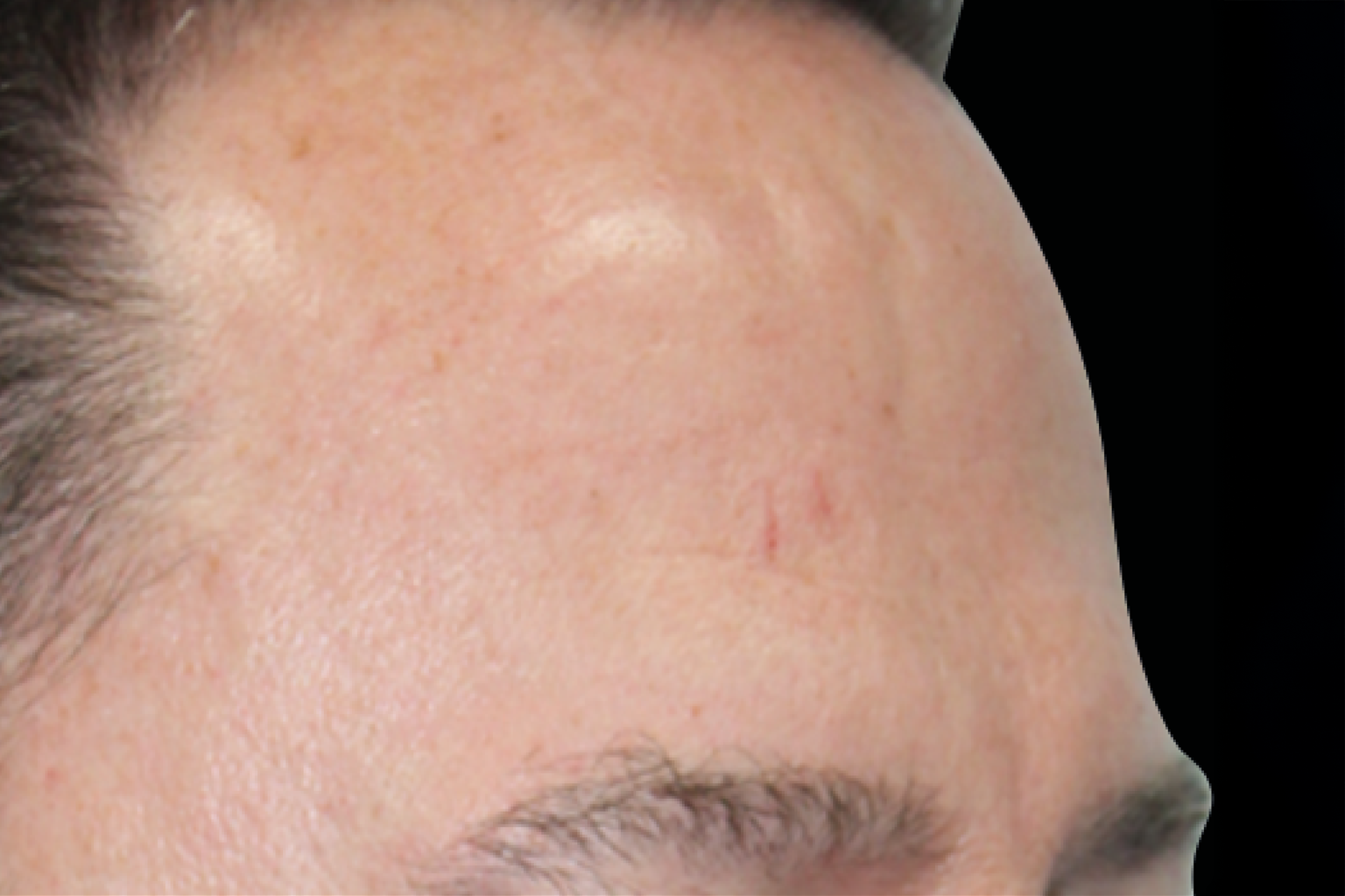 Close-up of a forehead with a few small red blemishes above the eyebrow
